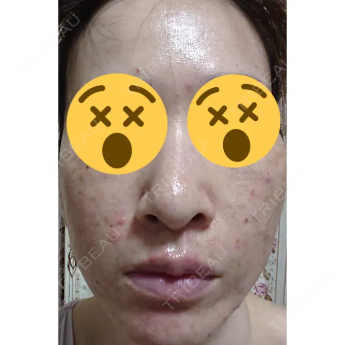 ほくろ・いぼ除去レーザー（肌） 広島プルミエクリニック DAY 5 メイン用