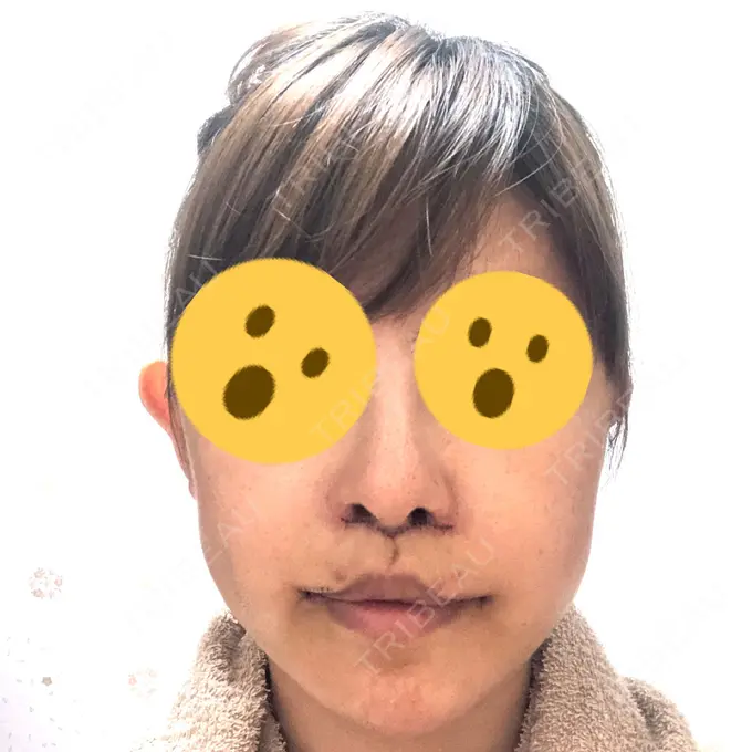 人中短縮 / 口角挙上 清潭女神美容外科 DAY 7 メイン用