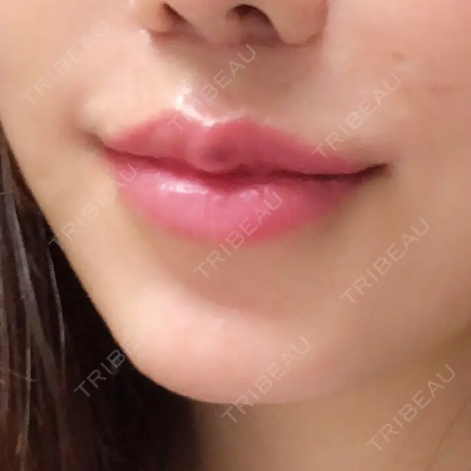 人中短縮 / 口唇縮小術 / 口角挙上 HB整形外科 AFTER メイン用