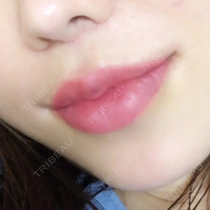 人中短縮 / 口唇縮小術 / 口角挙上 HB整形外科 DAY 167 メイン用