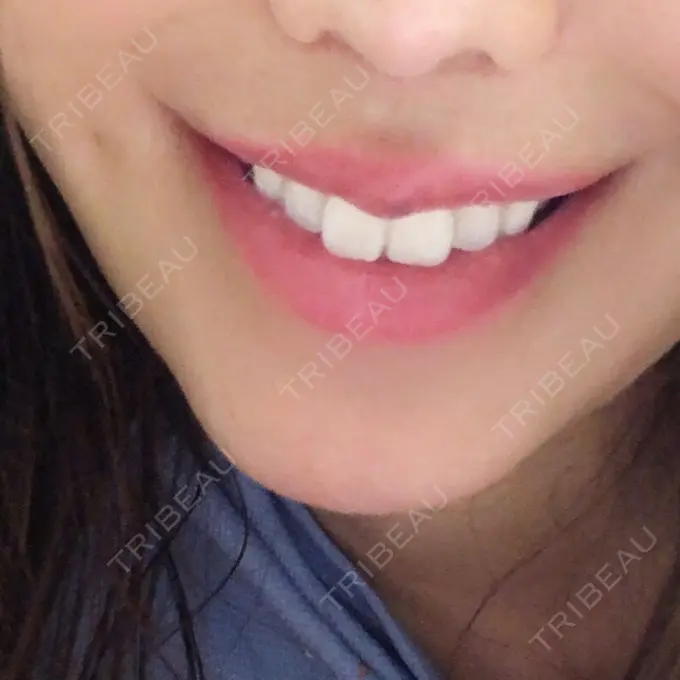 人中短縮 / 口唇縮小術 / 口角挙上 HB整形外科 DAY 167 メイン用