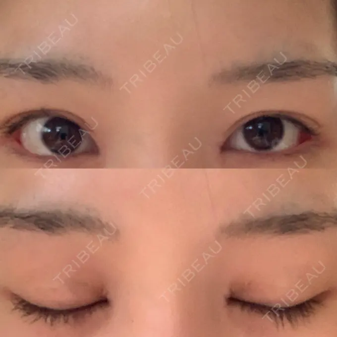 目頭切開 / 目尻切開 新宿ラクル美容外科クリニック 新宿院 DAY 12 メイン用
