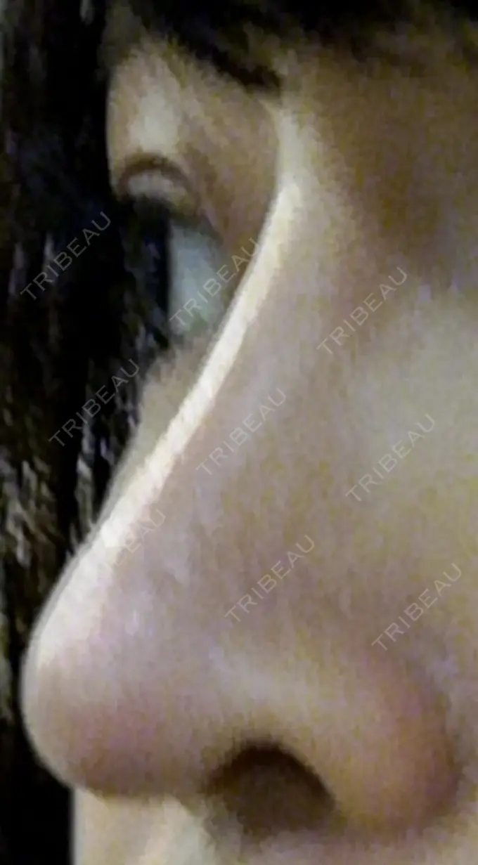 隆鼻術 / 鼻尖形成（切開） / 軟骨移植 ヤスミクリニック DAY 25 メイン用