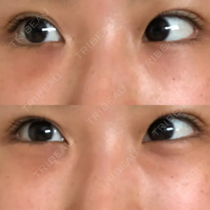 クマ治療 韓国ST美容整形外科 AFTER メイン用