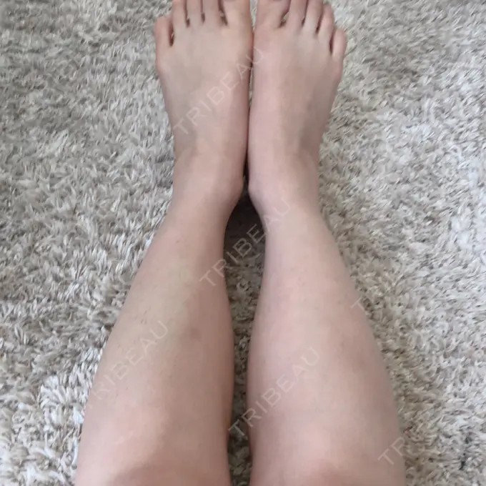 ボトックス（ふくらはぎ） ガーデンクリニック 名古屋院 DAY 13 メイン用