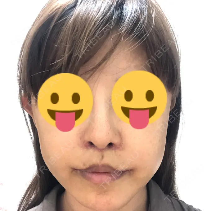 人中短縮 / 口角挙上 清潭女神美容外科 DAY 9 メイン用