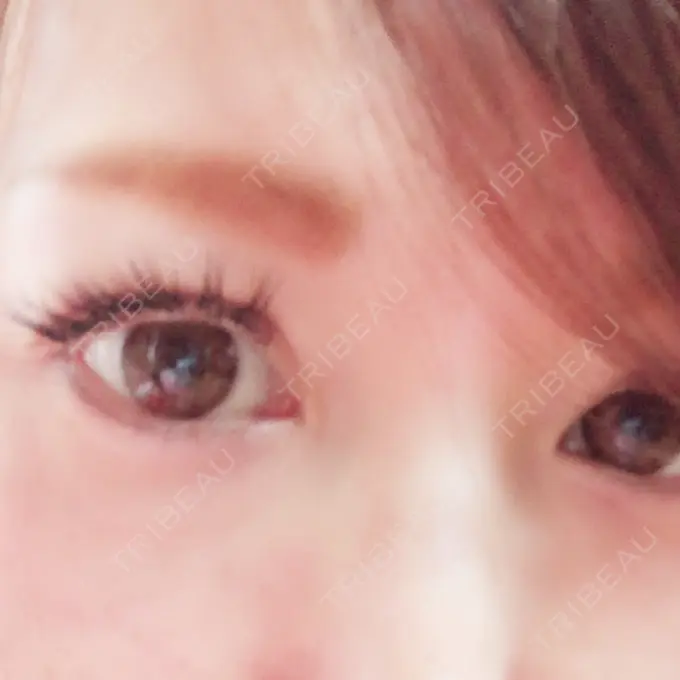 二重埋没 湘南美容クリニック 東京蒲田院 AFTER メイン用