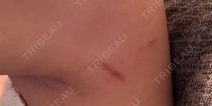 脂肪吸引（二の腕） ヨンセスリムライン DAY 81 メイン用