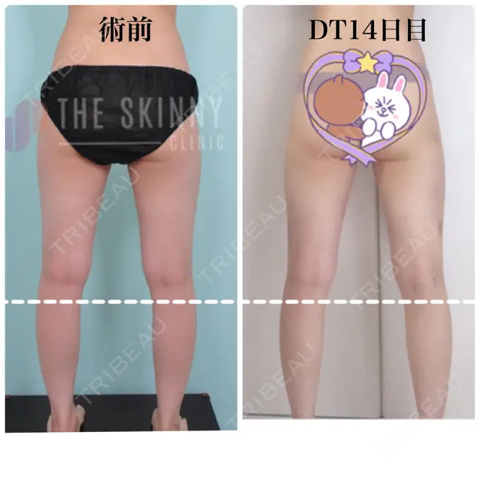 ボトックス（ふくらはぎ） / 脂肪溶解注射 / 脂肪溶解注射（太もも） / その他（ボディ） THE SKINNY CLINIC（ザ・スキニークリニック） DAY 14 メイン用