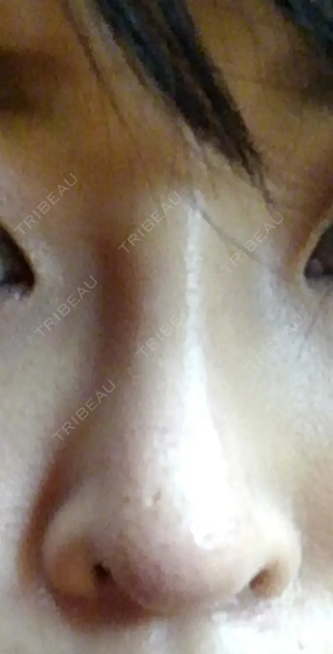 隆鼻術 / 鼻尖形成（切開） / 軟骨移植 ヤスミクリニック DAY 28 メイン用