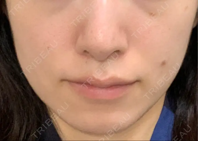 ボトックス（エラ・小顔） TCB東京中央美容外科 郡山院 DAY 95 メイン用