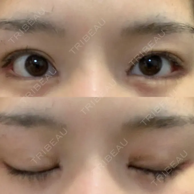 目頭切開 / 目尻切開 新宿ラクル美容外科クリニック 新宿院 DAY 13 メイン用