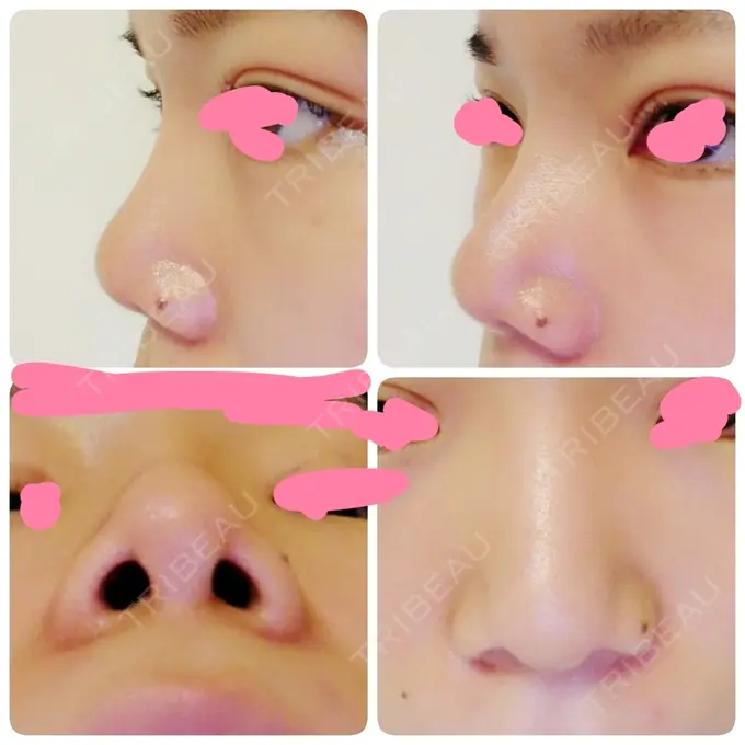 隆鼻術 / 鼻尖形成（切開） / 鼻尖縮小 ヤスミクリニック DAY 69 メイン用