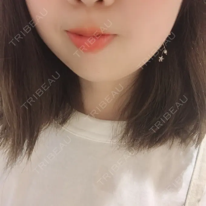 ボトックス（あご） 恵聖会クリニック 京橋院 AFTER メイン用