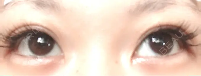 二重埋没 いわきタウン形成外科クリニック DAY 13 メイン用