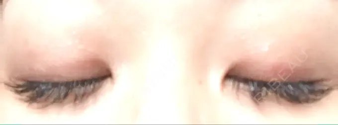 二重埋没 いわきタウン形成外科クリニック DAY 13 メイン用