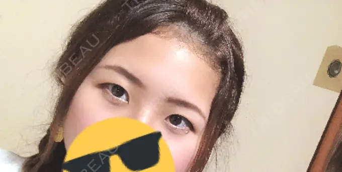 眼瞼下垂（切開） みずほクリニック AFTER メイン用