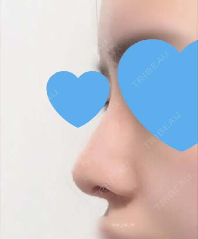 鼻尖形成（切開） / 鼻中隔延長（切開） / 軟骨移植 / 眉間プロテーゼ / 鼻修正 ミナ美容外科 AFTER メイン用
