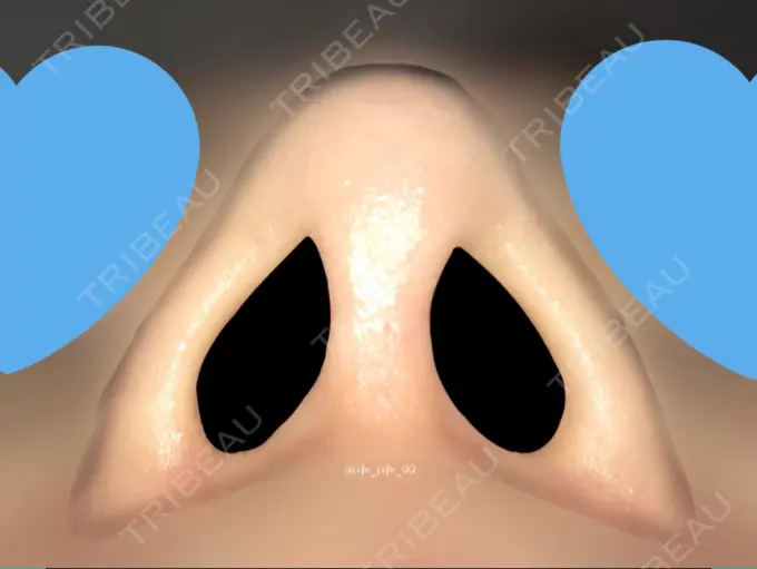 鼻尖形成（切開） / 鼻中隔延長（切開） / 軟骨移植 / 眉間プロテーゼ / 鼻修正 ミナ美容外科 DAY 181 メイン用