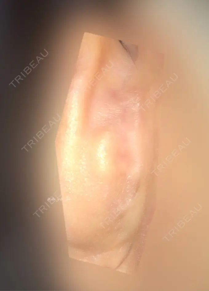 鼻尖形成（切開） / 鼻中隔延長（切開） / 軟骨移植 / 眉間プロテーゼ / 鼻修正 ミナ美容外科 DAY 181 メイン用