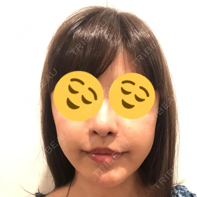 人中短縮 / 口角挙上 清潭女神美容外科 DAY 11 メイン用