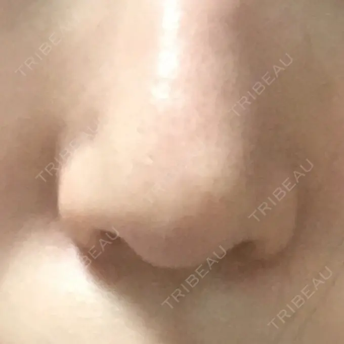 小鼻縮小（切開） プラストクリニック DAY 63 メイン用