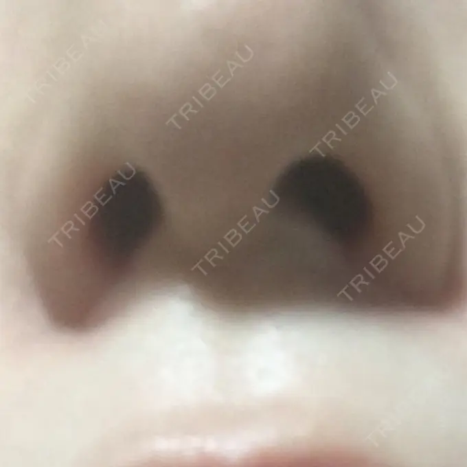 小鼻縮小（切開） プラストクリニック DAY 63 メイン用