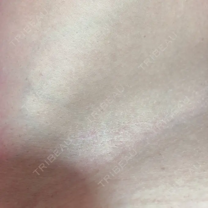 脂肪吸引（脚） THE CLINIC（ザ・クリニック） 名古屋院 DAY 64 メイン用