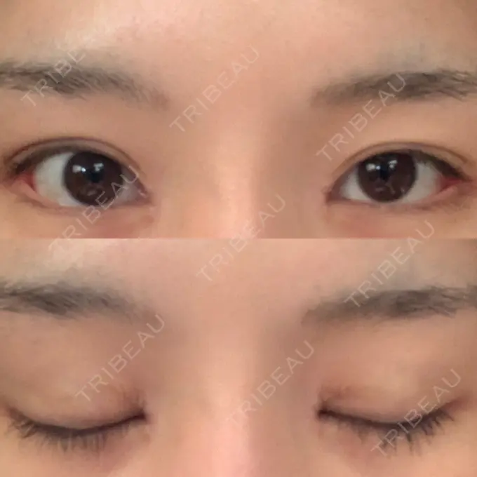 目頭切開 / 目尻切開 新宿ラクル美容外科クリニック 新宿院 DAY 15 メイン用