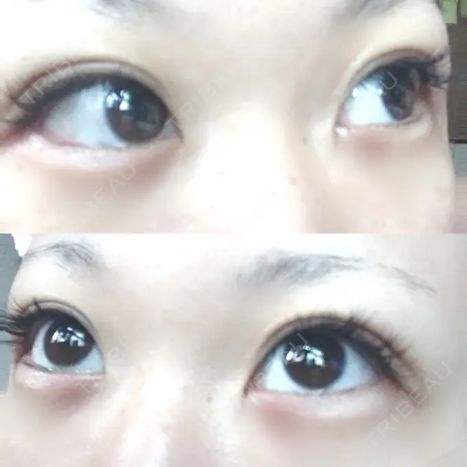 二重埋没 いわきタウン形成外科クリニック DAY 14 メイン用