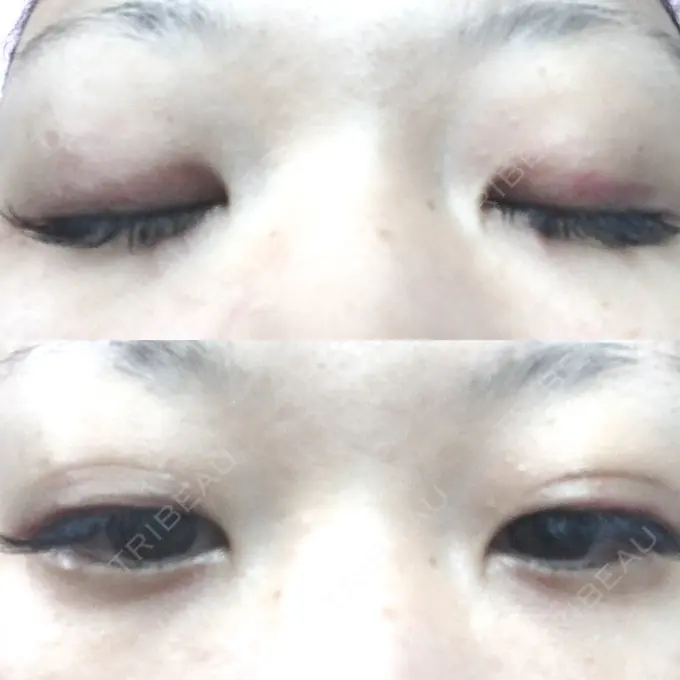 二重埋没 いわきタウン形成外科クリニック DAY 14 メイン用