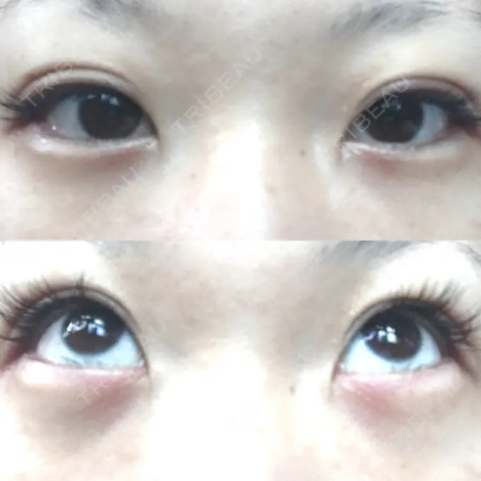 二重埋没 いわきタウン形成外科クリニック DAY 14 メイン用