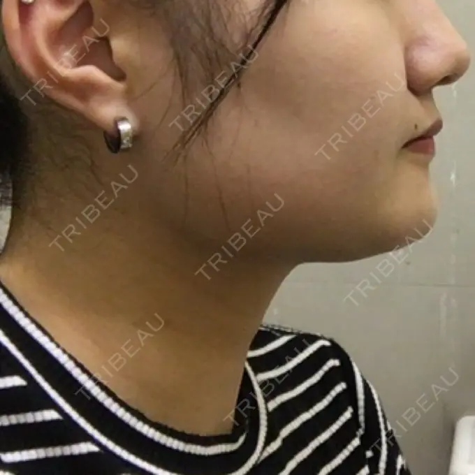 脂肪吸引（顔） アサミ美容外科 渋谷院 DAY 72 メイン用