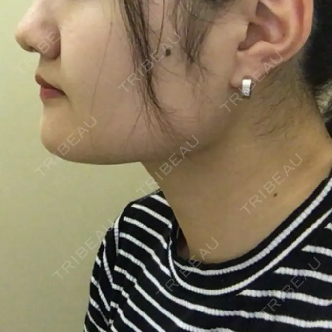 脂肪吸引（顔） アサミ美容外科 渋谷院 DAY 72 メイン用