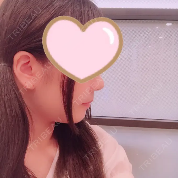 セットバック 大塚美容形成外科・歯科 大塚本院 DAY 19 メイン用