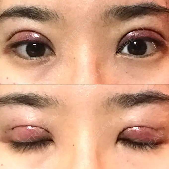 二重切開 医療法人美彩会 グランクリニック DAY 1 メイン用