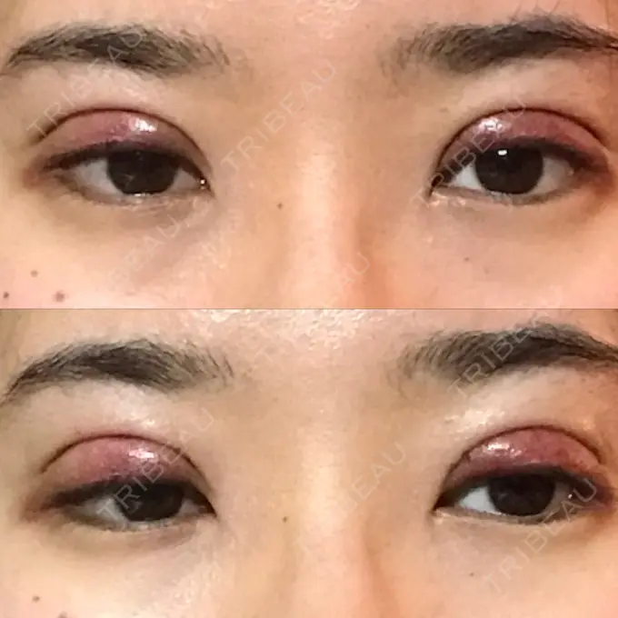 二重切開 医療法人美彩会 グランクリニック DAY 1 メイン用