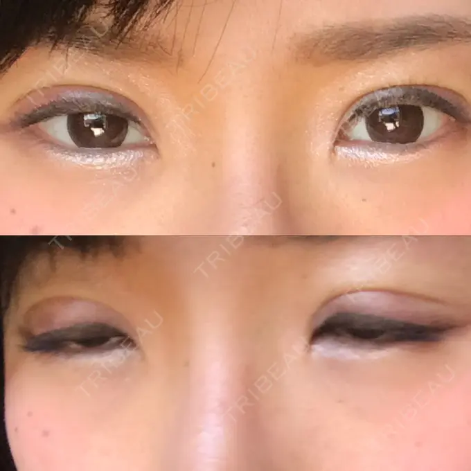 二重切開 医療法人美彩会 グランクリニック DAY 8 メイン用