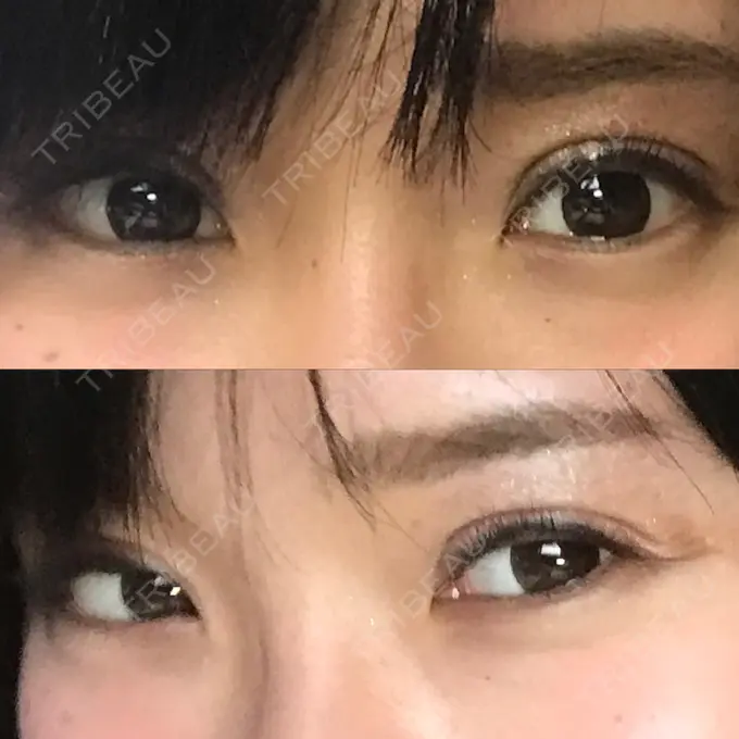 二重切開 医療法人美彩会 グランクリニック DAY 10 メイン用