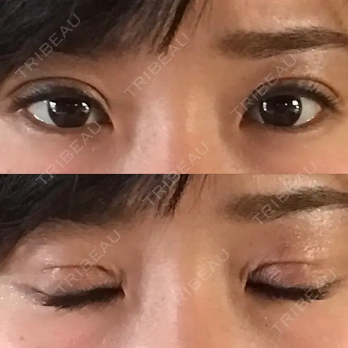 二重切開 医療法人美彩会 グランクリニック DAY 10 メイン用