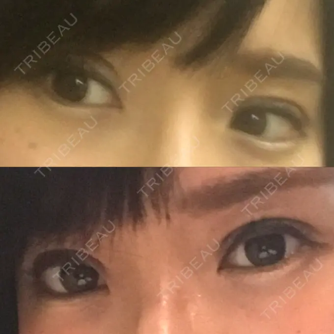 二重切開 医療法人美彩会 グランクリニック DAY 27 メイン用