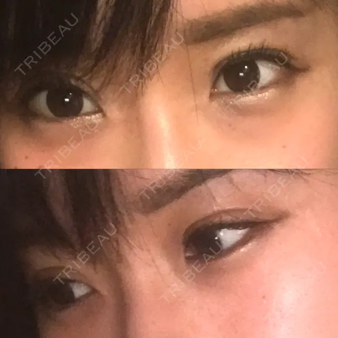 二重切開 医療法人美彩会 グランクリニック DAY 37 メイン用