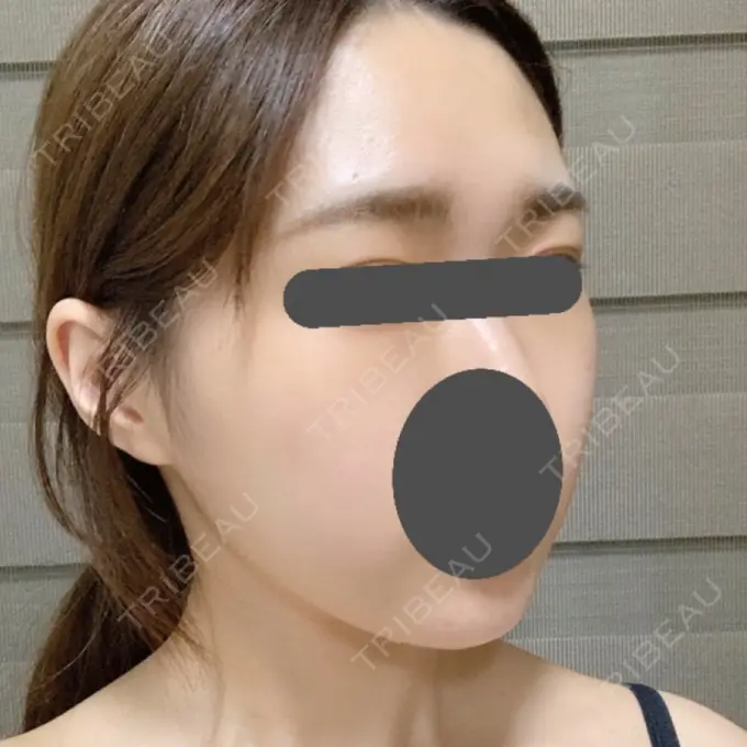 脂肪吸引（顔） / ボトックス（あご） / ヒアルロン酸注入（あご） / ボトックス（エラ・小顔） プチパーティー医院 DAY 29 メイン用