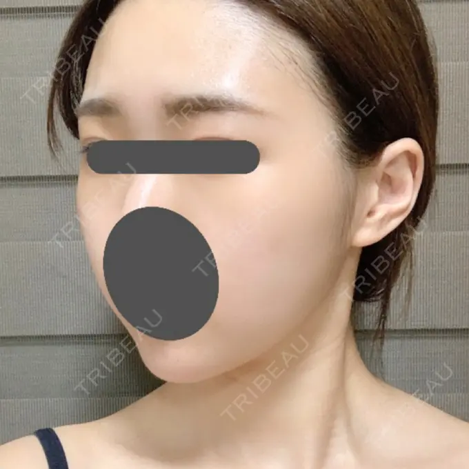 脂肪吸引（顔） / ボトックス（あご） / ヒアルロン酸注入（あご） / ボトックス（エラ・小顔） プチパーティー医院 DAY 29 メイン用