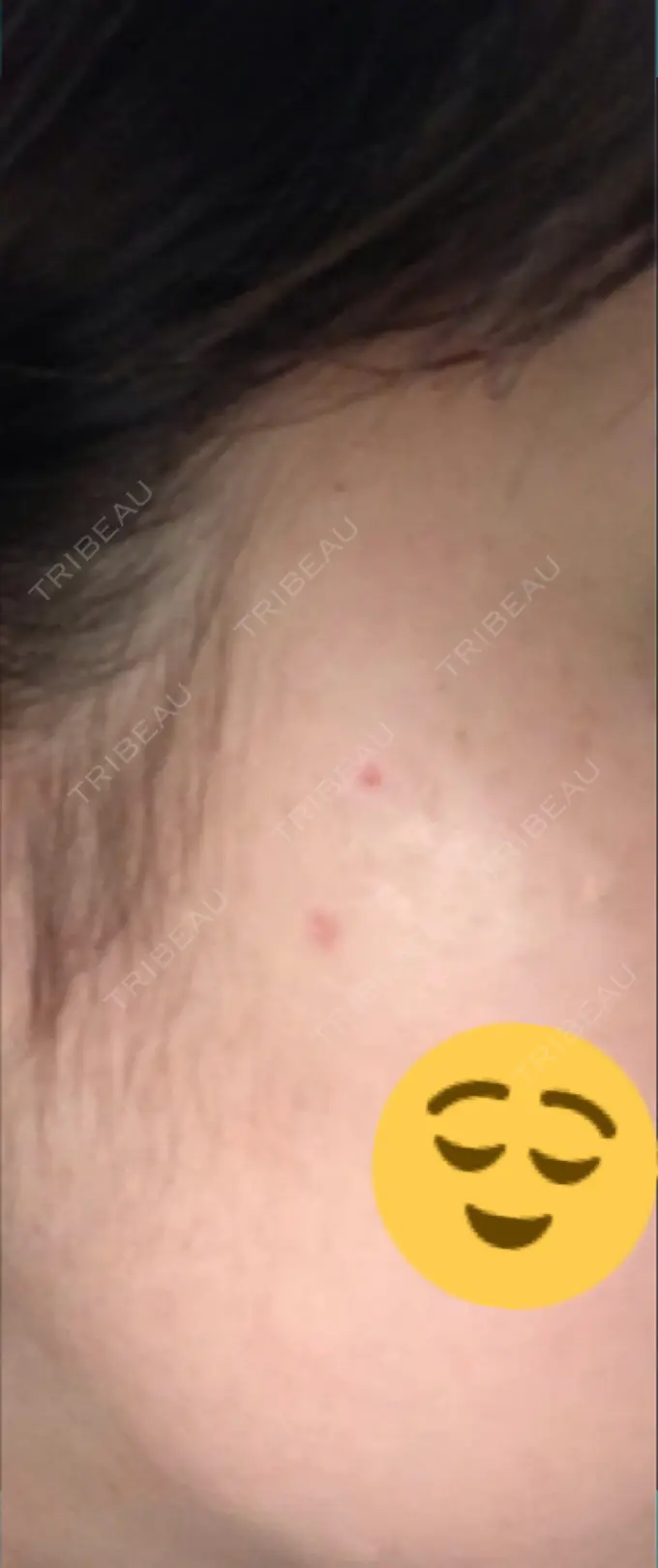 ほくろ・いぼ切除（肌） シンシアガーデンクリニック 太田院 DAY 14 メイン用