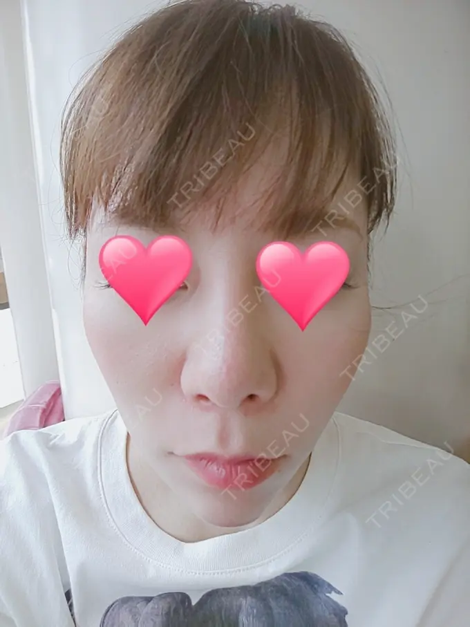 隆鼻術 品川スキンクリニック岡山院 DAY 61 メイン用