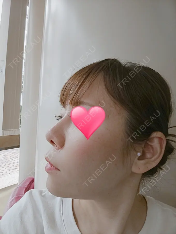 隆鼻術 品川スキンクリニック岡山院 DAY 61 メイン用