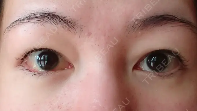 クマ治療 / 下まぶたたるみ取り / 下まぶたの脂肪取り / 脂肪注入（肌） コスメディカルクリニック シンシア 銀座院 DAY 11 メイン用