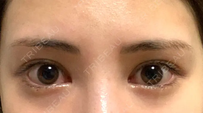 目頭切開 / 目尻切開 / 目尻靭帯移動 DIVINE（ディバイン）整形外科 AFTER メイン用