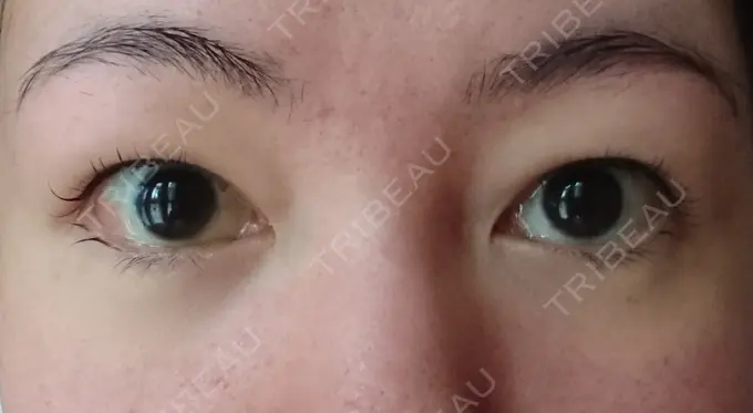 クマ治療 / 下まぶたたるみ取り / 下まぶたの脂肪取り / 脂肪注入（肌） コスメディカルクリニック シンシア 銀座院 DAY 12 メイン用